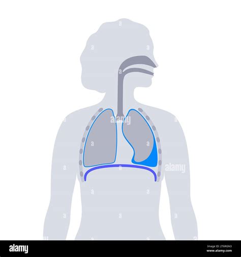 Pleural Effusion Illustration Stock Photo Alamy