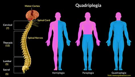 Quadriplegia Physiotherapy Treatment Step Forward Physiotherapy Clinic