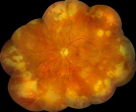 Treatment Of Acute Retinal Necrosis Syndrome With Oral Antiviral