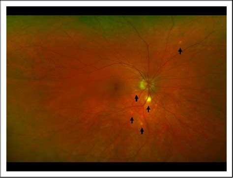 Figure 1 From Multiple Evanescent White Dot Syndrome Presenting In A