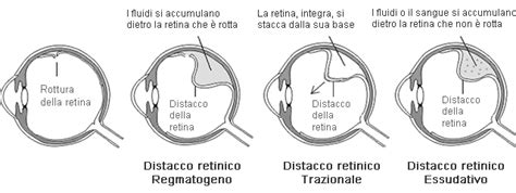 Sintomi Distacco Di Retina