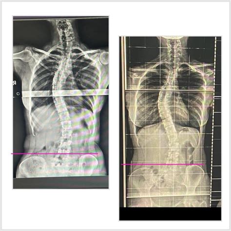 Can someone tell why these vertebrae looks fuse and is there someone ...