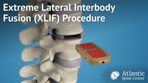 Extreme Lateral Interbody Fusionxlif Procedure Youtube