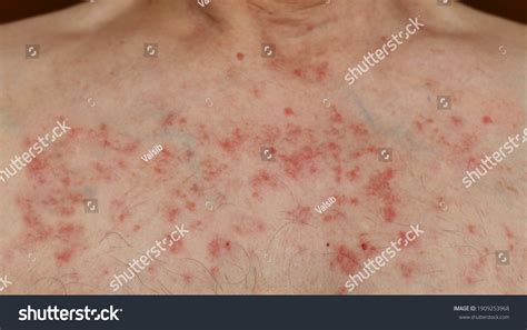 599 Rash chest Stock Photos, Images & Photography | Shutterstock