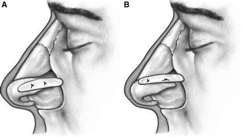 Grafts And Implants In Rhinoplastytechniques And Long Term Results