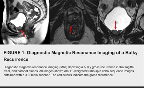 Figure From Mri Guided Dose Escalated Salvage Radiotherapy For Bulky