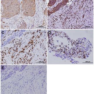 A Positive PD L1 Immunohistochemical Staining With A Membranous