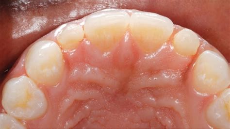 Management Of Peg Shaped Maxillary Lateral Incisors And Congenitally