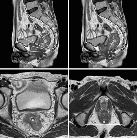 MRI-based pelvimetry. A: pelvic inlet; B: pubococcygeal distance; C:... | Download Scientific ...