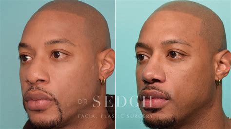 African American Rhinoplasty Before And After Dr Sedgh