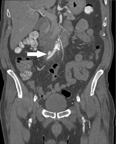 Aortitis Secondary To Common Iliac Artery Mycotic Aneurysm Journal Of