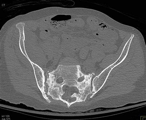 Abscess In Antecubital Fossa Musculoskeletal Case Studies Ctisus Ct