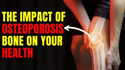 Understanding Osteoporosis Causes Symptoms And Management Youtube