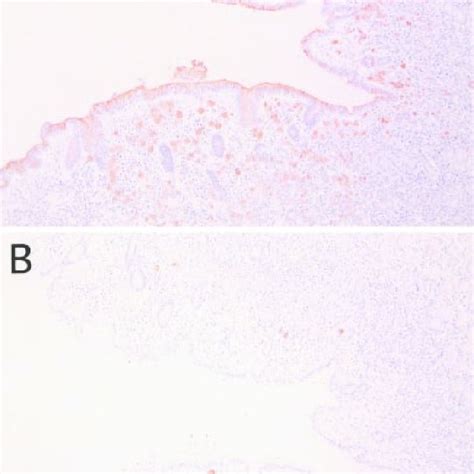 Mucin Stainings In An Intramucosal Signet Ring Cell Carcinoma Case No