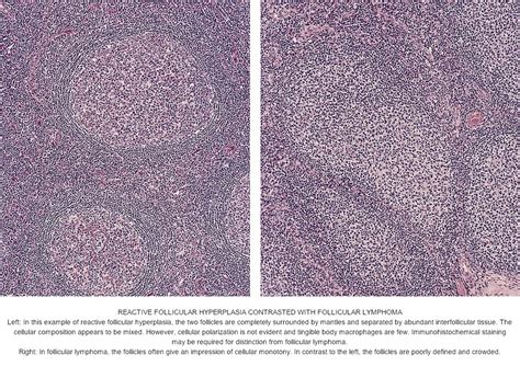 Pathology Outlines Follicular Hyperplasia