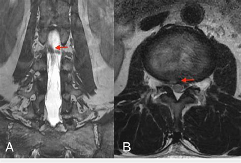 Three-month postoperative MRI (A) Although the position of the exiting ...