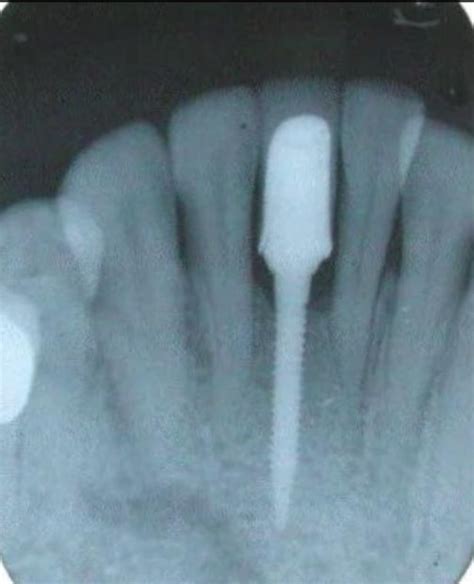 Radiograph Taken After A Week Following Insertion Of The PFM Crown