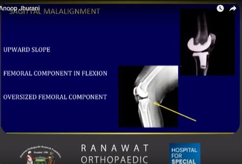 Painful Stiff Knee following Arthroplasty — OrthopaedicPrinciples.com