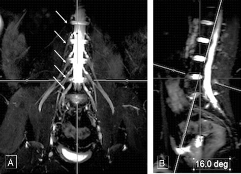 Figure 1 From 3d Mr Neurography Of The Lumbosacral Plexus Obtaining