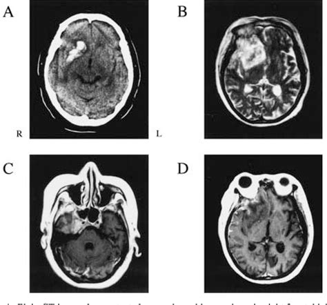 Figure 1 From Venous Infarction Secondary To Septic Cavernous Sinus Thrombosis Semantic Scholar