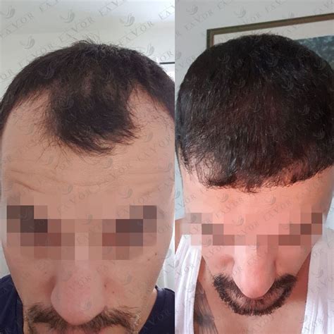 Best Hair Transplant In Turkey Trustpilot Lorette Bradshaw