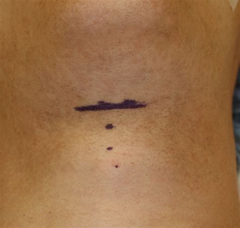 Tracheal Shave | Seattle Facial Plastic Surgeon| Dr. Lamperti | Seattle, WA