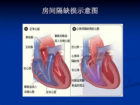 常见先天性心脏病 龙华医院肾内科 蔡小凡 Ppt Download