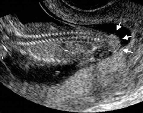 First‐trimester Diagnosis Of Sacrococcygeal Teratoma The Role Of Three