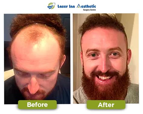 Laser Inn Best Hair Transplant Results Best Fue Hair Transplant