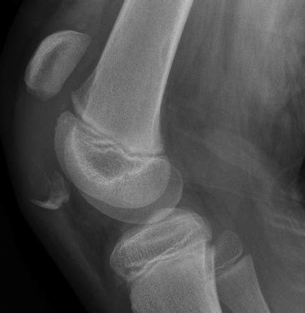 Patella Sleeve Fracture - Pediatrics - Orthobullets