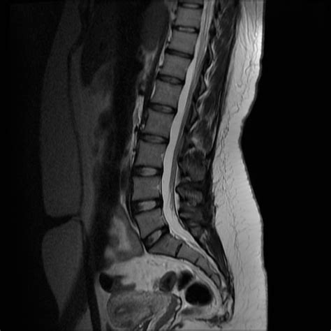 Lumbar Spine: Reading Mri Lumbar Spine