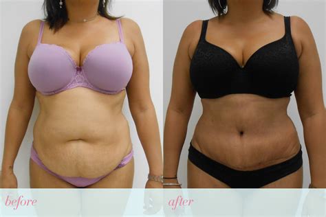 Tummy Tuck Surgery Miami - Abdominoplasty | Dr. Bernabe Vazquez