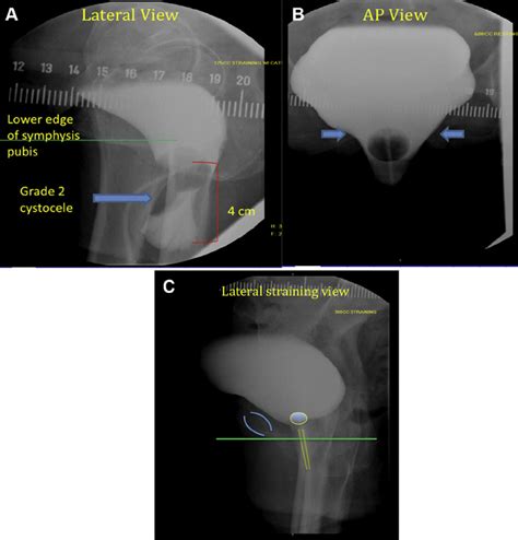 (A) Grade 2 (2 e 5 cm) cystocele with lateral height at 4 cm on voiding... | Download Scientific ...