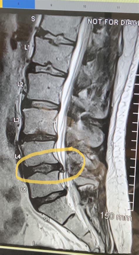 MRI -Herniated L4-L5 disc - the herniated portion of the disc is ...