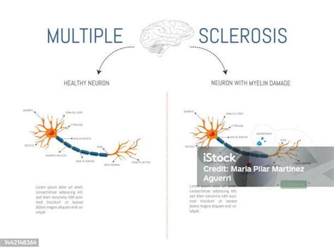 Infographic Of A Healthy Neuron And One With Damage From Attack By Myelindestroying Lymphocytes