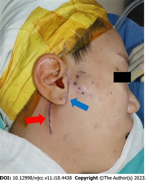 Removal Of Unexpected Schwannoma With Superficial Parotidectomy Using