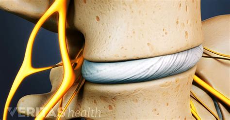 Anterior Lumbar Interbody Fusion (ALIF) Surgery | Spinal fusion surgery ...