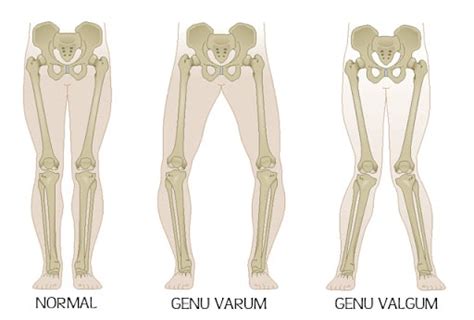 Genu Valgum En Musculation Comment Le Corriger