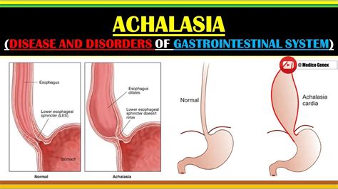 ACHALASIA CAUSES OF ACHALASIA SIGN AND SYMPTOMS OF ACHALASIA