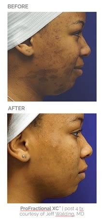 Debunking Common Myths About Treating Skin Of Color With Lasers Sciton