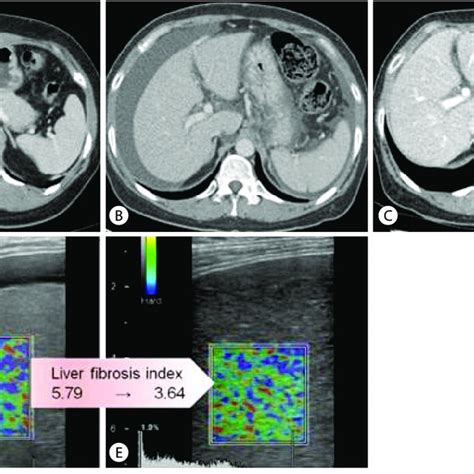 Dynamic Contrast Enhanced Computed Tomography Ct Images In The Portal