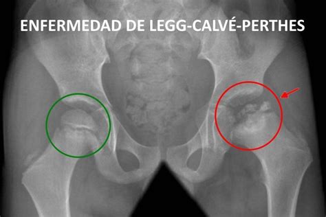 La Enfermedad de Perthes mejora si se trata en la cámara hiperbárica