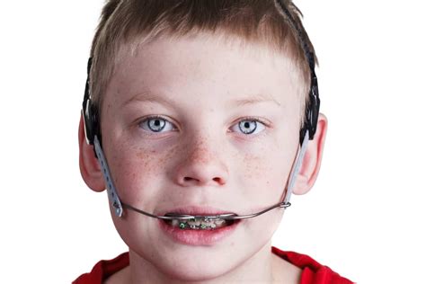 What Is Orthodontic Headgear? - ArchWired