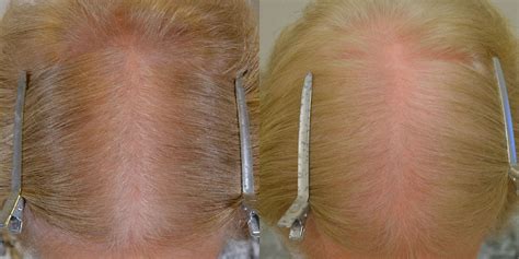 Finasteride Females Before And After Photos Hair Restoration Of The