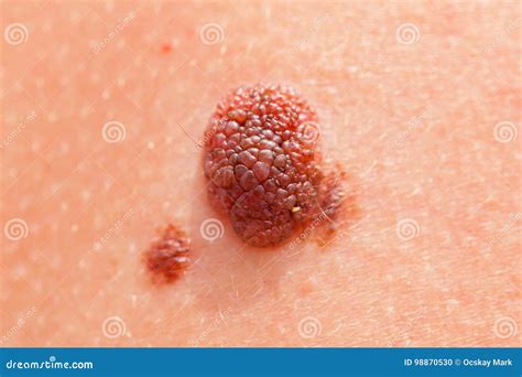 Brown Nevus On Human Skin Stock Photo Image Of Medical 98870530