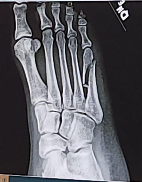 My Zone 3 Midshaft Fracture Of The 5th Metatarsal Before And After