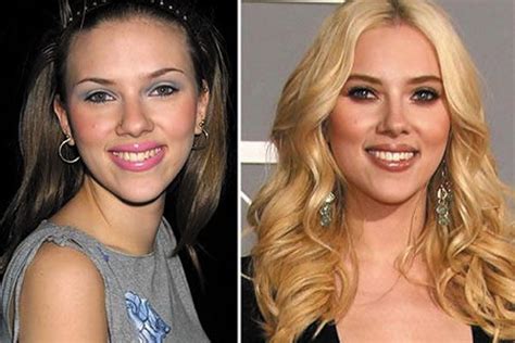 Scarlett Johansson Plastic Surgery Has She Had A Nose Job Nose Job