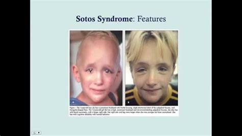 Sotos Syndrome - CRASH! USMLE Step 2 and 3 | Syndrome, Soto, Youtube