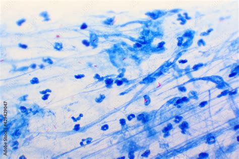 Mycobacterium Tuberculosis Positive Small Red Rod In Sputum Smear