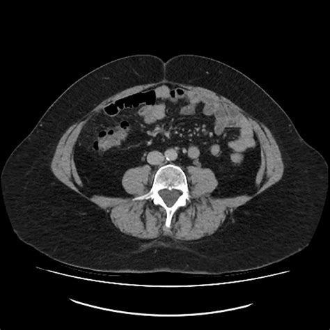 Appendiceal Mucocele Image Radiopaedia Org